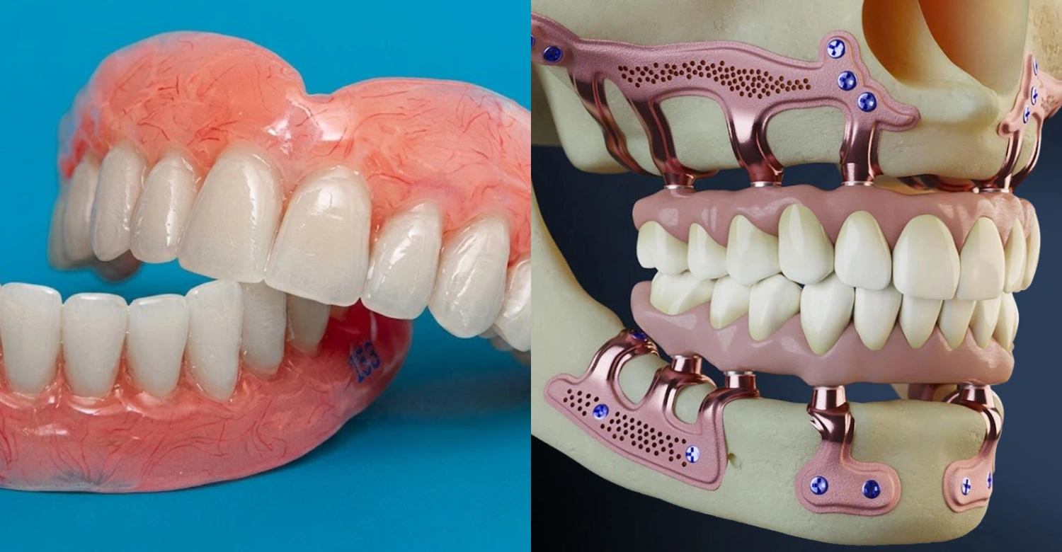 Subperiosteal Implants vs Dentures Inblog
